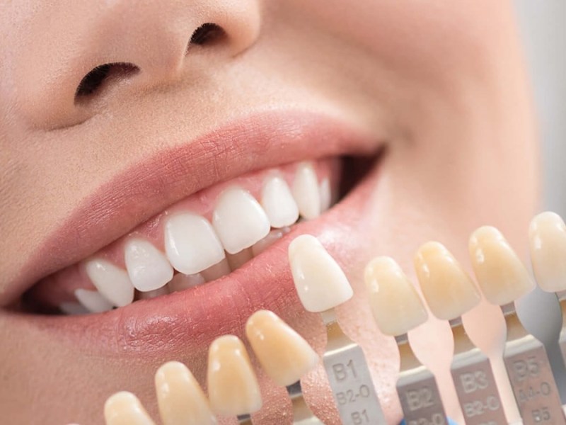 Bonded Veneers: A Perfect Solution for Your Dream&nbsp;Smile