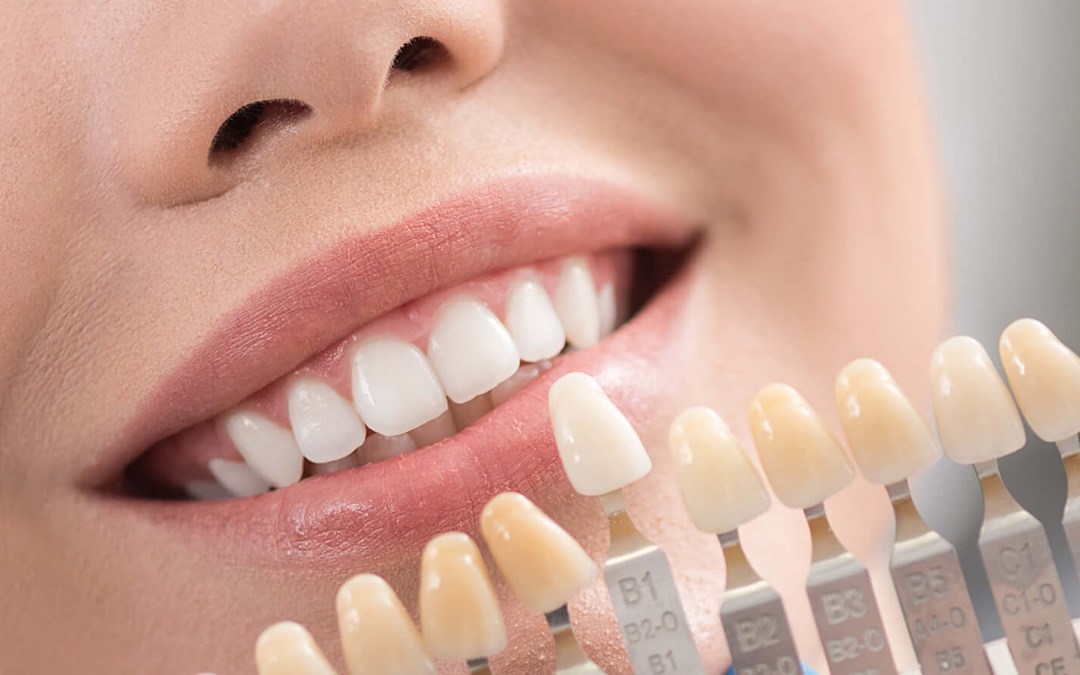 Bonded Veneers: A Perfect Solution for Your Dream&nbsp;Smile